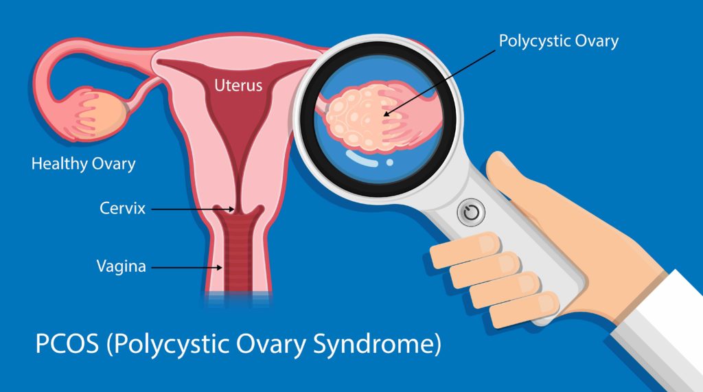 Things You Must Know If You Have Pcos Pristyn Care