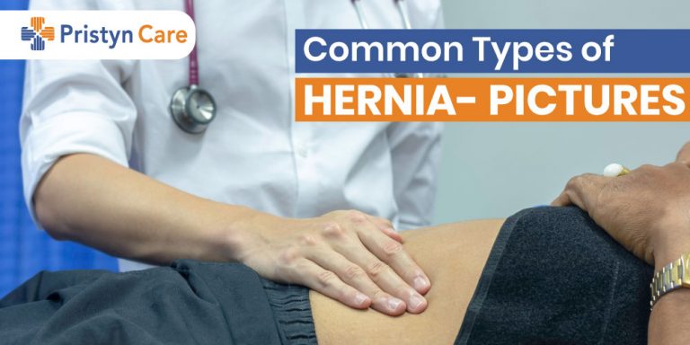 Types Of Hernia Pictures Inguinal Hiatal Femoral Ventral Epigastric