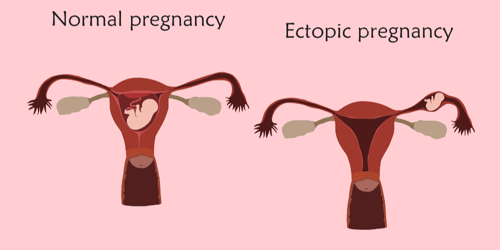 Symptoms Of Ectopic Pregnancy Pristyn Care