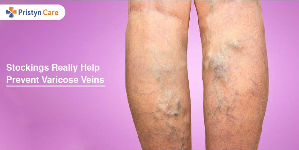 varicose veins treatment stockings