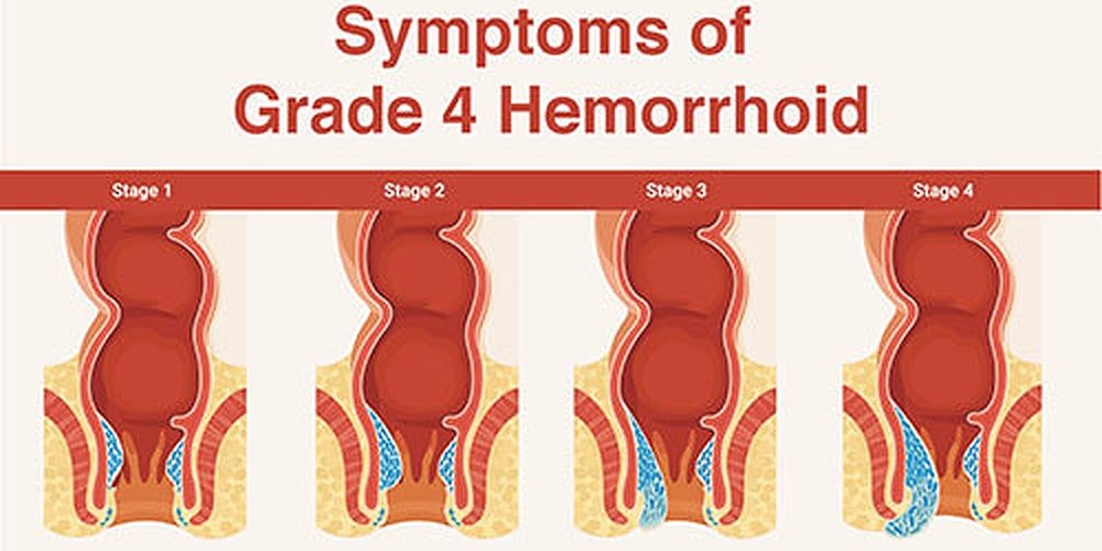 What Is Grade 3 Or Grade 4 Hemorrhoids