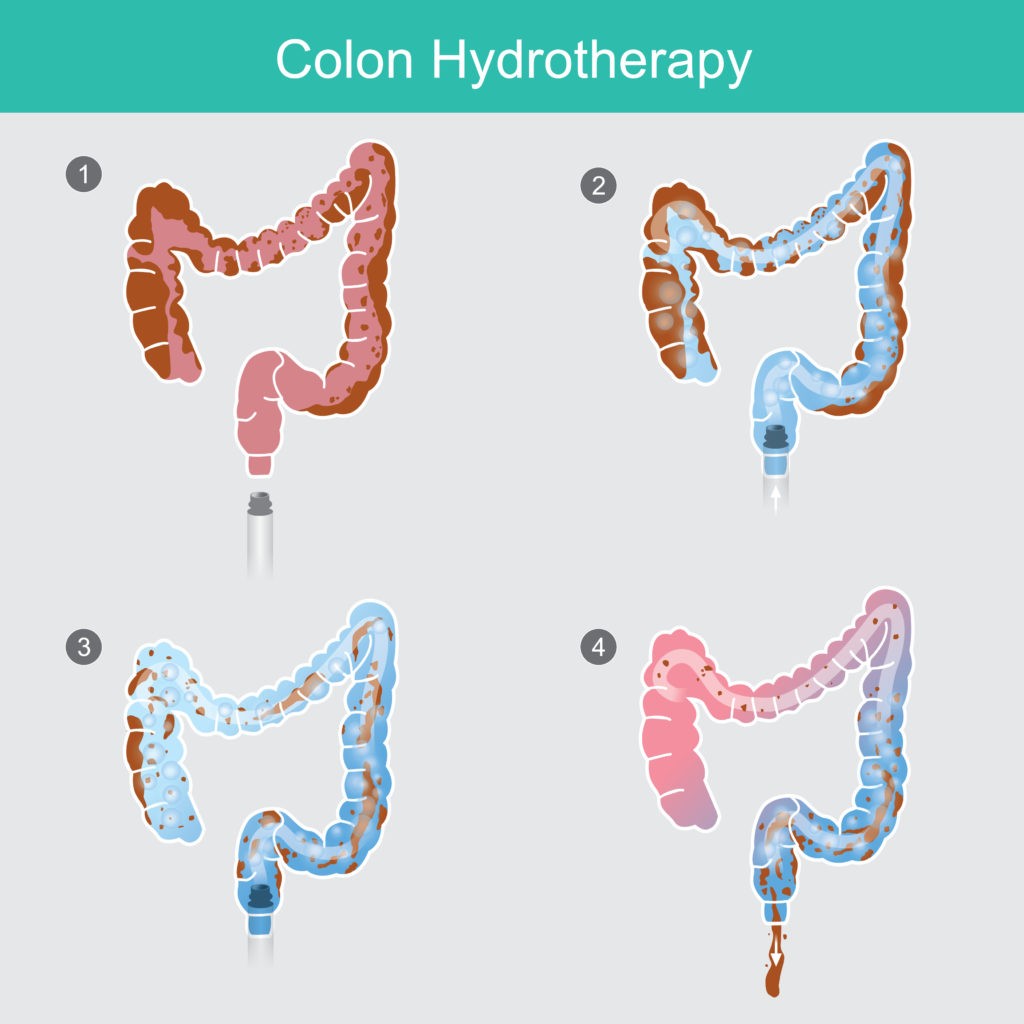 Colon Hydrotherapy Procedure Video