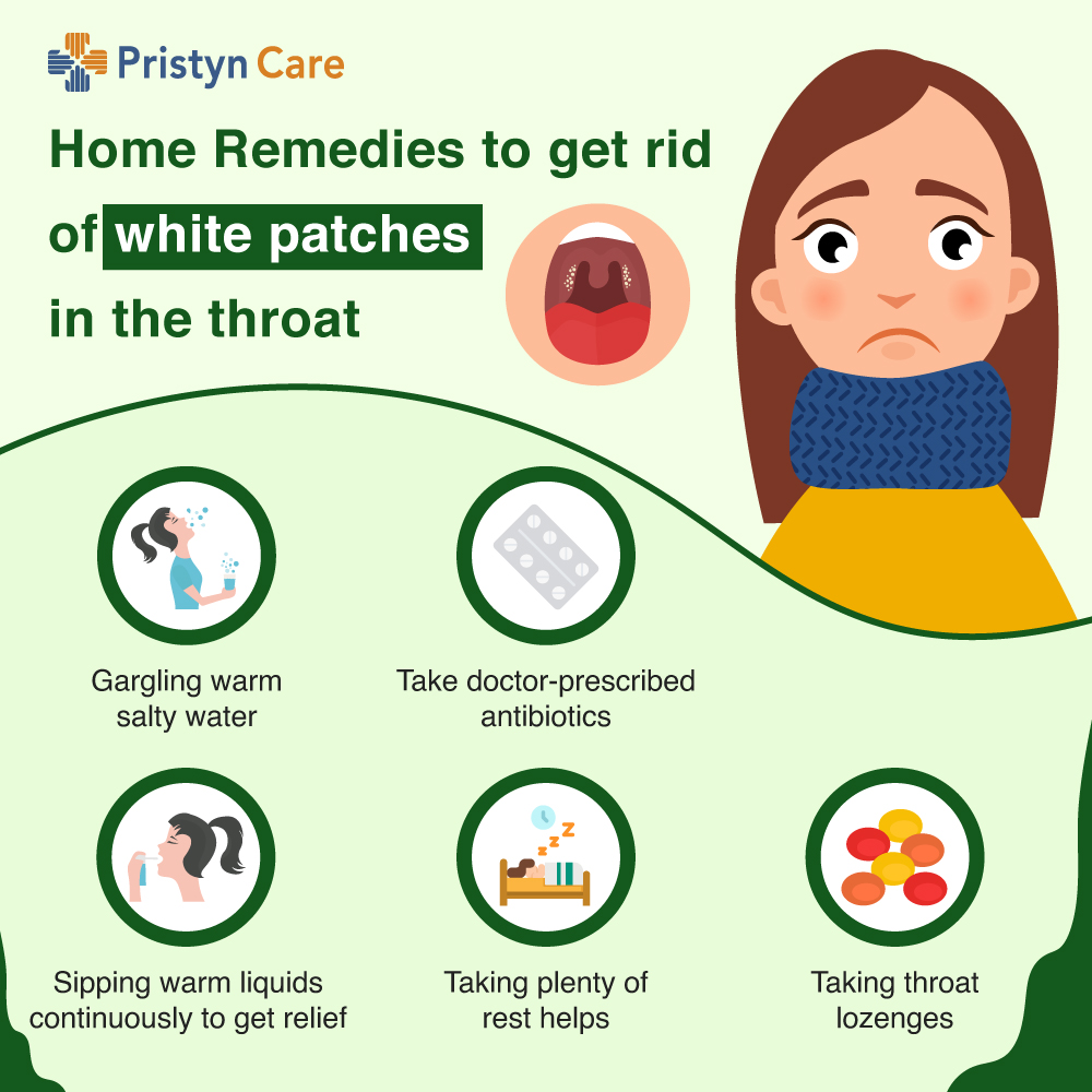 A Must Read For White Spots On The Throat Doctor s Advice