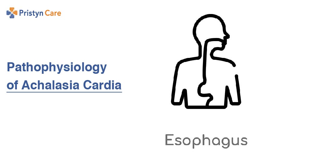 Pathophysiology of Achalasia Cardia