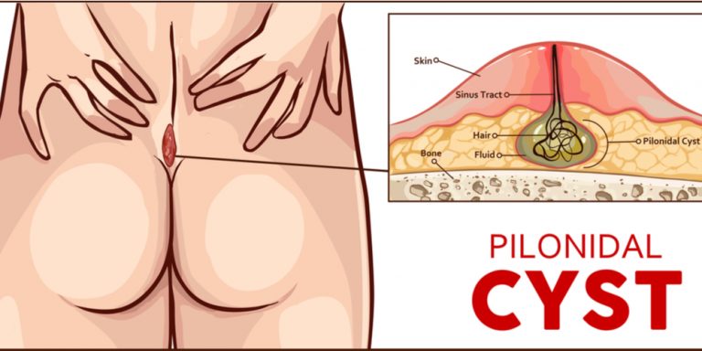 Pilonidal Cyst Self-Care Tips - GoodRx