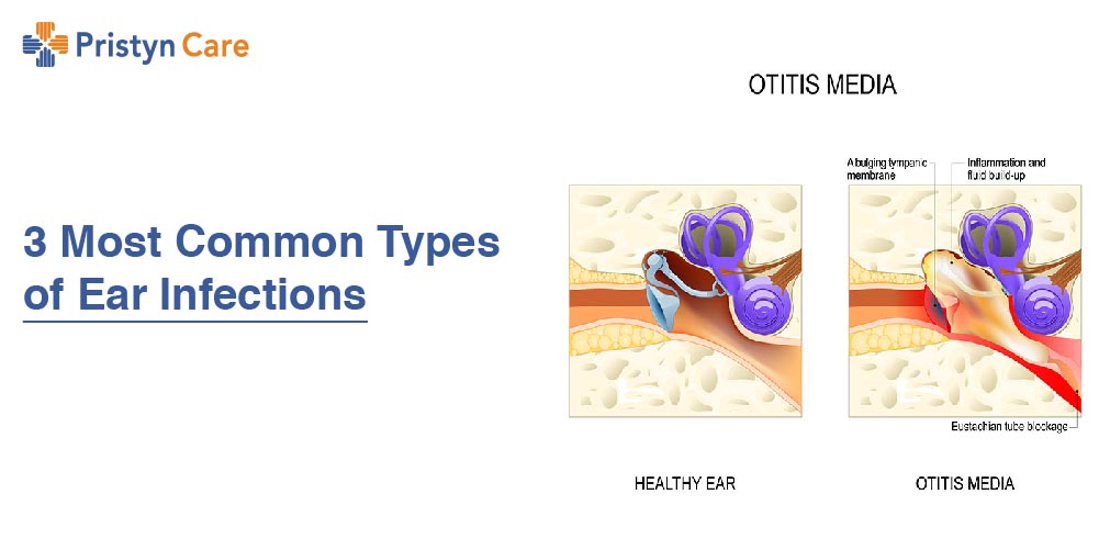 learn-more-about-types-of-ear-infections