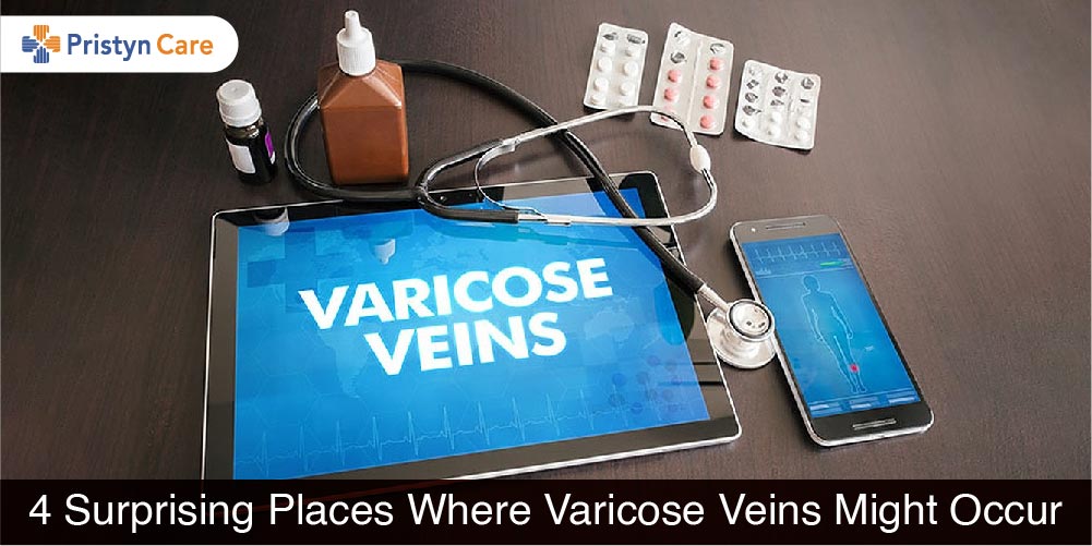 4 Surprising Places Where Varicose Veins Might Occur