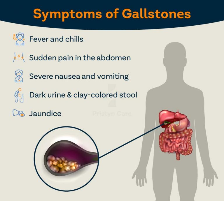 Gallstone Removal Without Surgery Remove Gallstone At Home