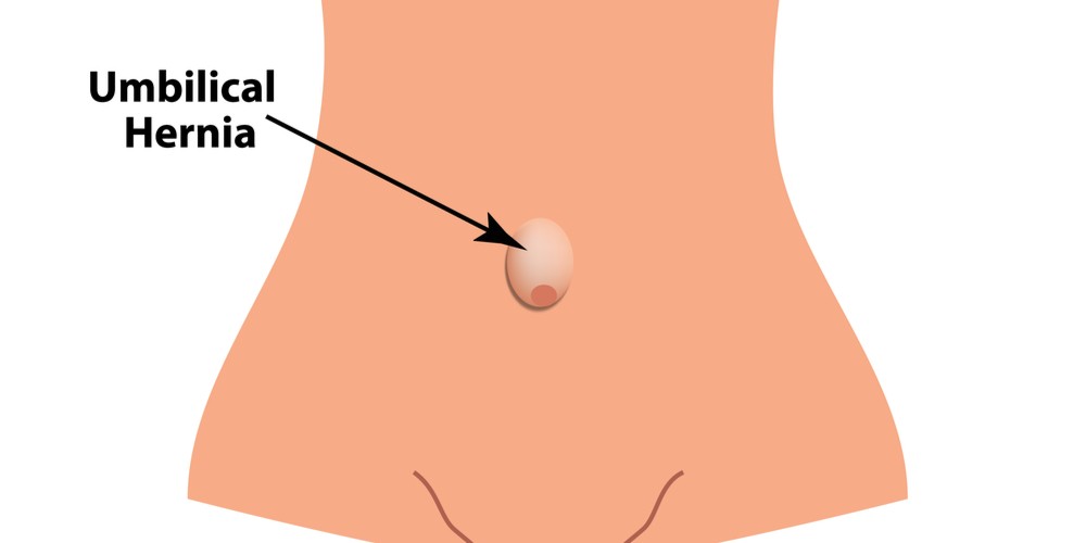Umbilical Hernia in Adults & Babies: Causes, Treatment, Surgery