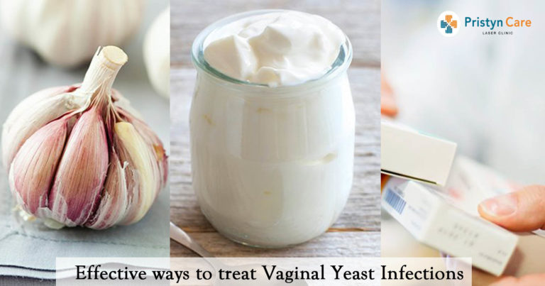 Effective Ways To Treat Vaginal Yeast Infections