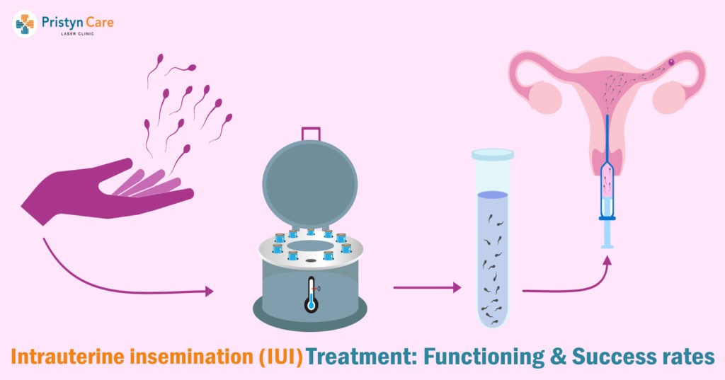 Intrauterine Insemination IUI Treatment Functioning Success Rates