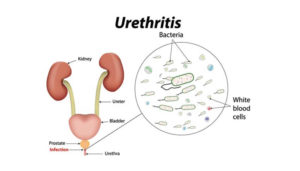 What is Urethritis? Know the Causes, Symptoms and Treatment