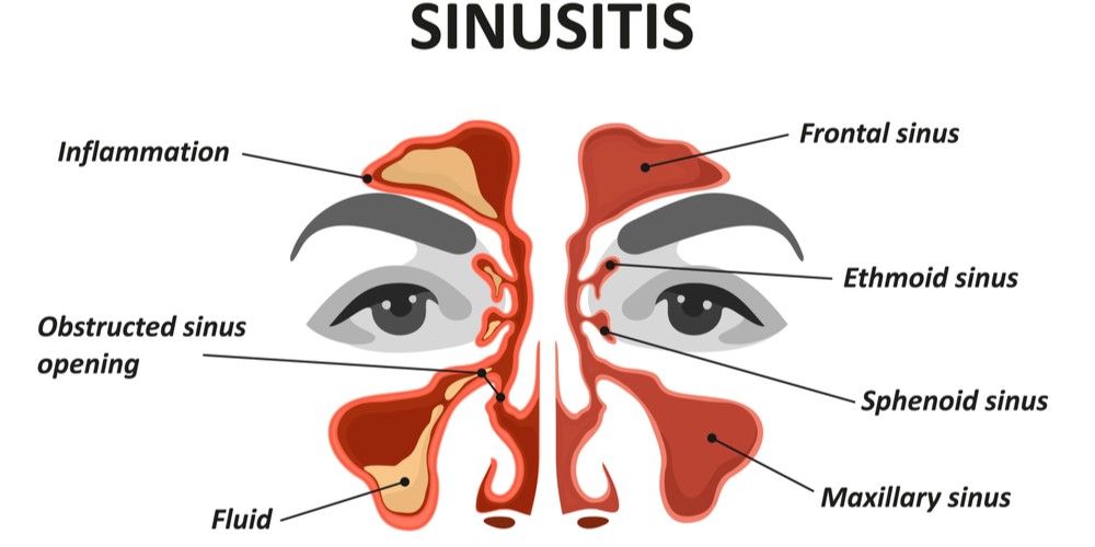 cover-image-for-effectiveness-of-balloon-sinuplasty