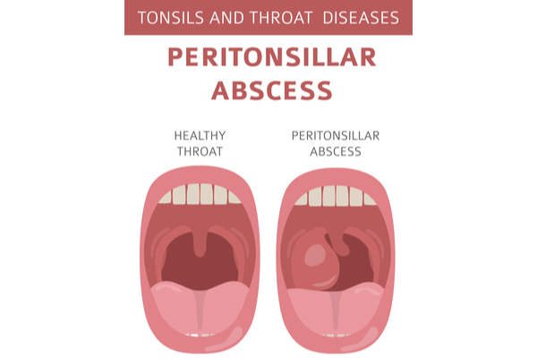 5 Major Complications Of Tonsillitis Pristyn Care