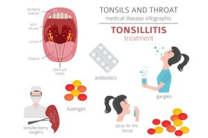 Tonsillitis in Kids: Symptoms, Causes, Diagnosis, and Treatment