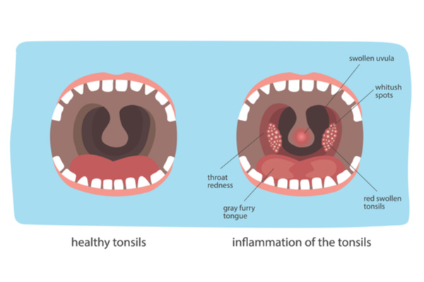 Tonsillitis In Kids Symptoms Causes Diagnosis And Treatment