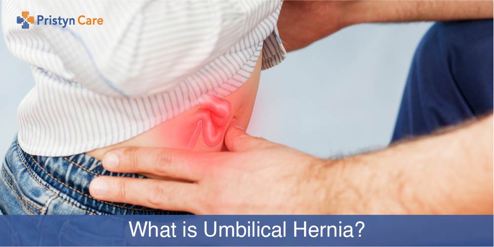 what is umbilical hernia