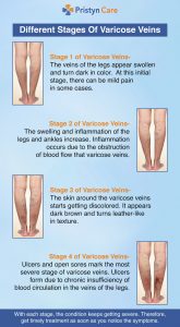 Varicose Veins Stages - Pristyn Care