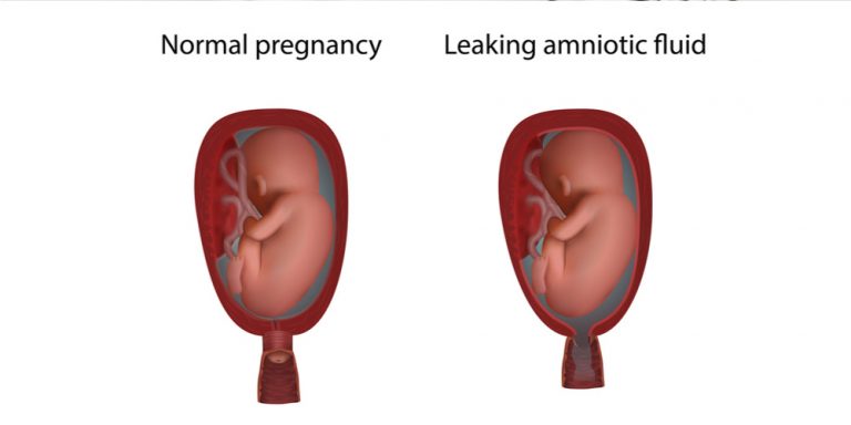 leaking amniotic fluid in toilet