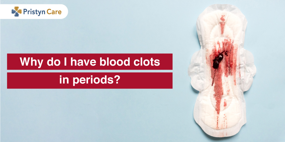 Symptom of endometriosis, menstrual blood with blood clots on a