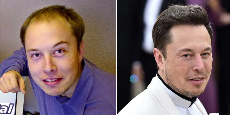 How Elon Musk Got His New Look With Hair Transplantation - Pristyn Care