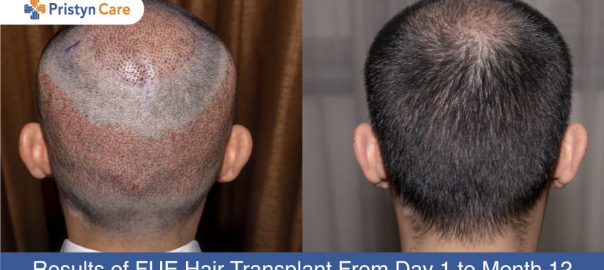 the result of 9 months 4000 grafts after fue hairtransplant with este future in turkey on do hair implants last forever