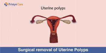 Surgical Removal Of Uterine Polyps Pristyn Care