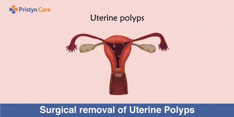 surgical-removal-of-uterine-polyps-pristyn-care