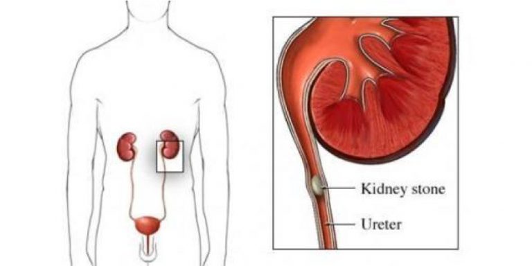 are-kidney-stones-dangerous-pristyn-care