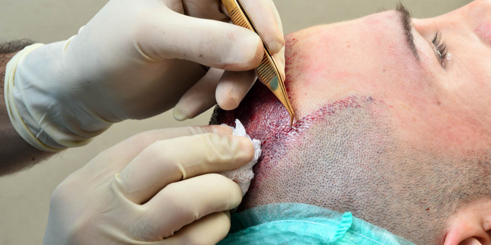 Man going through hair transplantation