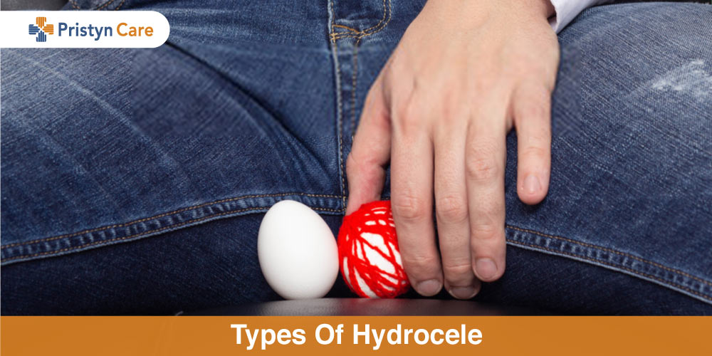 types of hydrocele