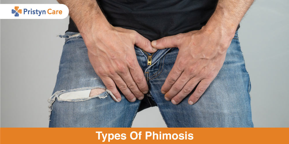 Phimosis Explained: The Road to Recovery and Treatment Options 