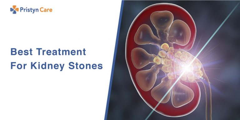 Can You Pass An 8mm Kidney Stone? - Pristyn Care