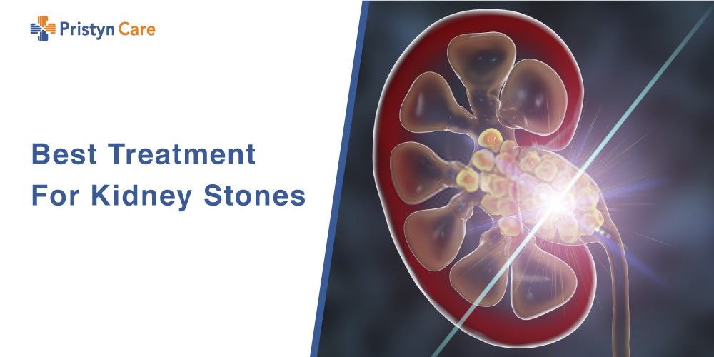 Best Treatment For Kidney Stones Pristyn Care