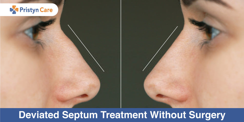 what can you do with a deviated septum