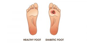 Diabetic Foot Ulcers Symptoms Causes And Risk Factors Pristyn Care