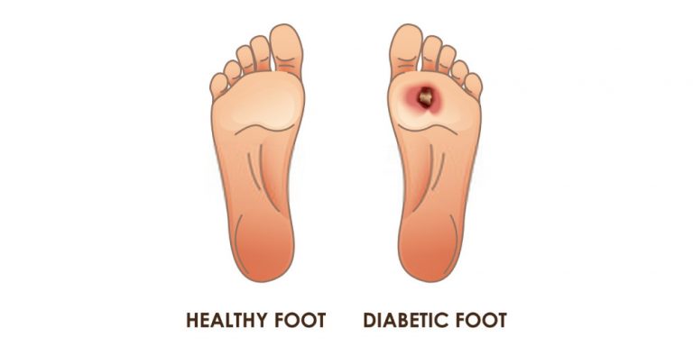 Diabetic Foot Ulcers- Symptoms, Causes, And Risk Factors - Pristyn Care