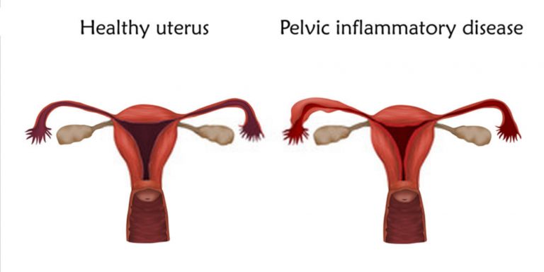 Pelvic Inflammatory Disease Symptoms Causes Risk