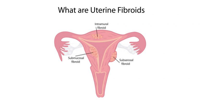 Does Uterine Fibroid Cause Weight Gain Pristyn Care 