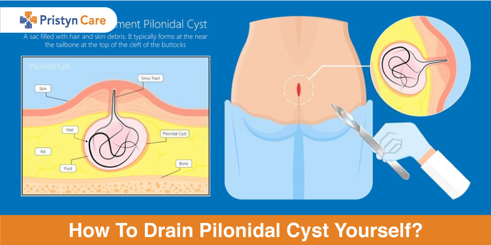 How To Drain Pilonidal Cyst Yourself?