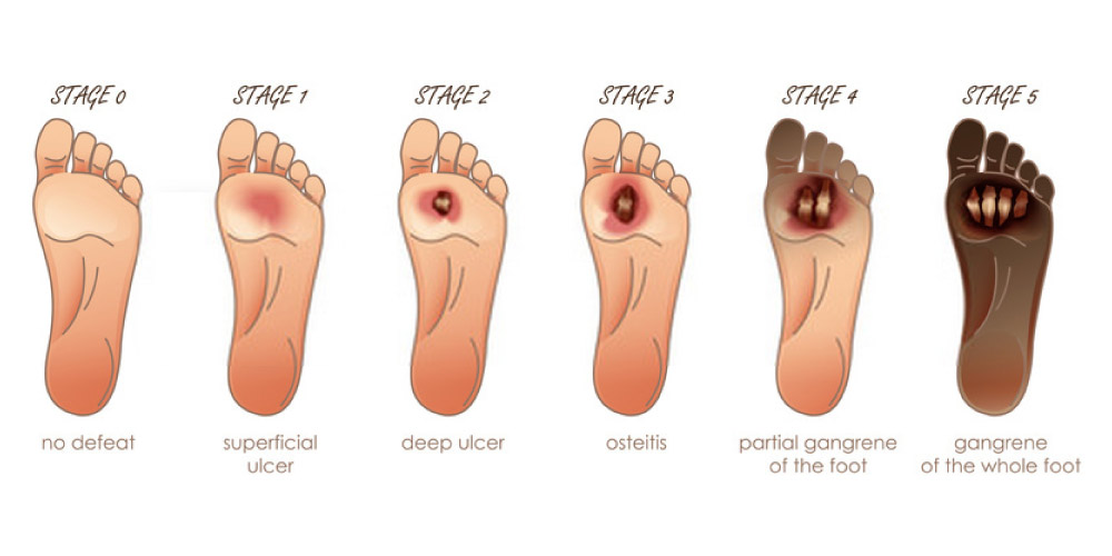 case study on diabetic foot ulcer
