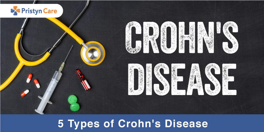 5 Types of Crohn's Disease - Pristyn Care