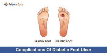 Complications Of Diabetic Foot Ulcer - Pristyn Care