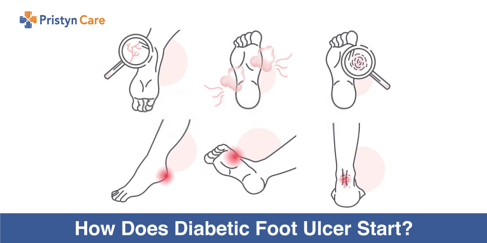 How-Does-Diabetic-Foot-Ulcer-Start