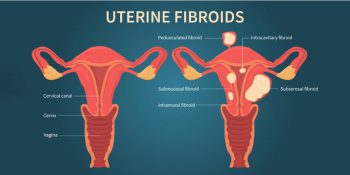 Enlarged Uterus Complications - Causes, and Treatments - Pristyn Care