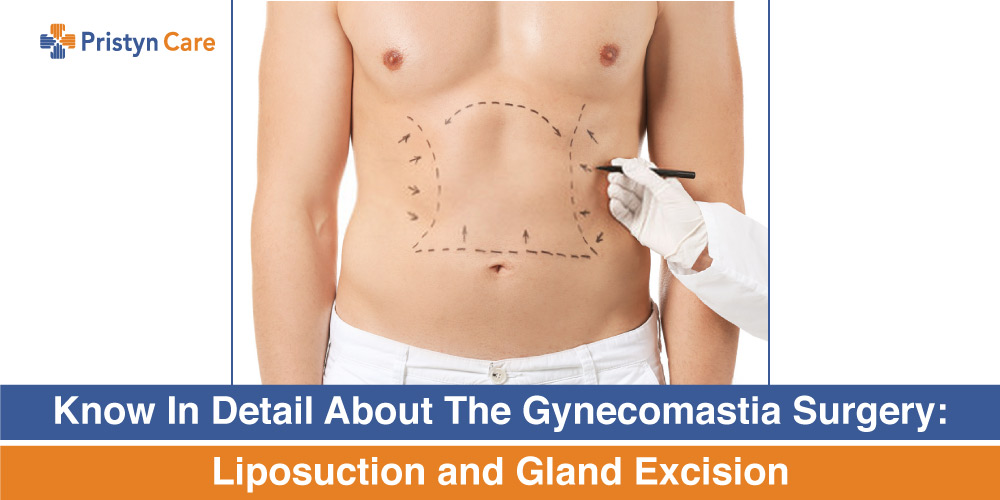 Know In Detail About The Gynecomastia Surgery Liposuction And Gland Excision Pristyn Care