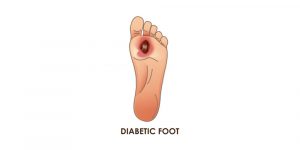 Signs And Symptoms Of Diabetic Foot Ulcer - Pristyn Care