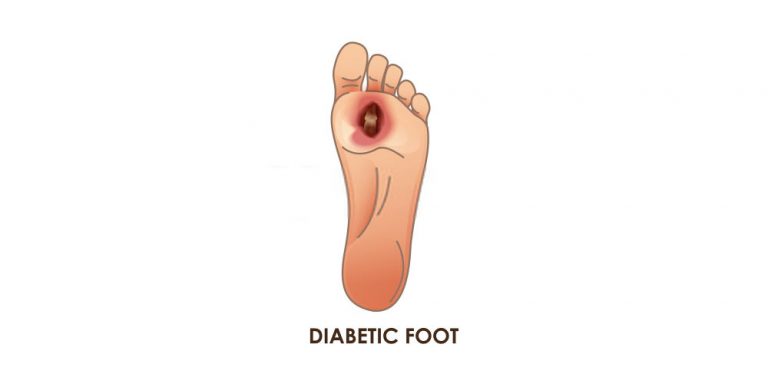 Signs And Symptoms Of Diabetic Foot Ulcer - Pristyn Care