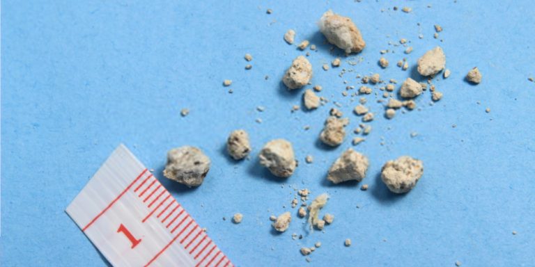 what-size-of-kidney-stones-require-surgery-pristyn-care