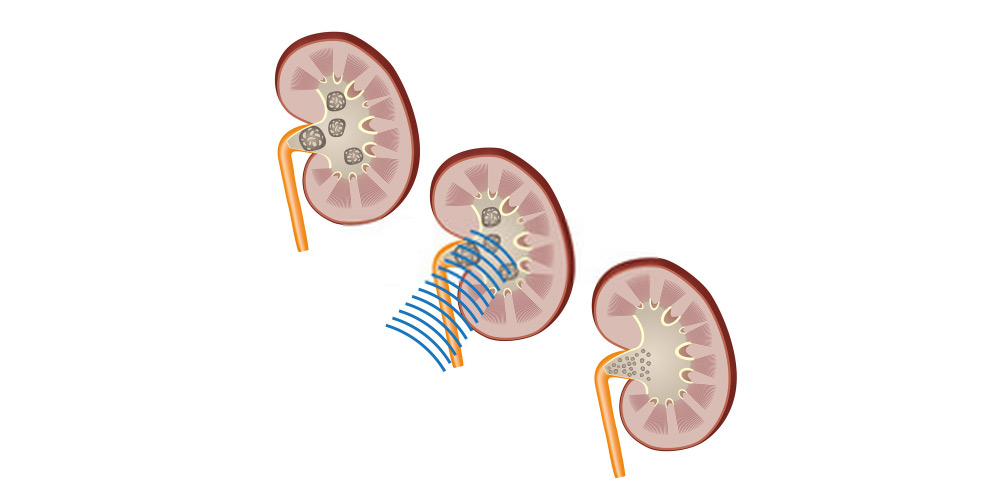 Kidney Stone Treatment Cost In Bangalore Pristyn Care